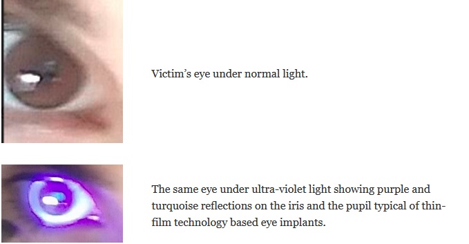 Eye thin film technology implants.jpg